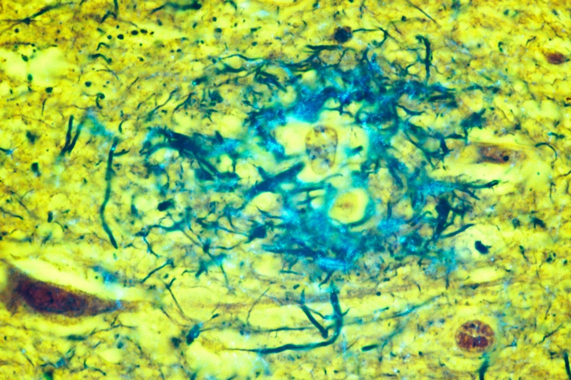 Diseased brain tissue from an Alzheimer's patient showing amyloid plaques (in blue) located in the gray matter of the brain.